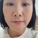 아이필유의원 | 강남역 실리프팅,아이필유 실리프팅 한 후기 -대 만족