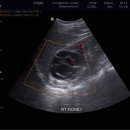 Multilocular cystic nephroma 이미지