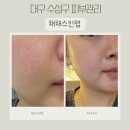대구랩서비스 | 대구 수성구 피부관리 모공 뿌시기 채채스킨랩