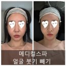경일메디칼 | 메디컬스파 청담얼굴붓기빼기, 림프순환마사지 3회차 후기