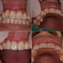 가든 치과기공소 | 앞니 부분교정 혹은 앞니 성형 지르코니아 크라운 치료. 선택은 환자가