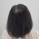 정재호 헤어 | 받는 20대여자를 구원해준...홍대smp 홍대두피채움 전문가 "헤드샷스칼프제이닷"에서 헤어라인 받은 후기