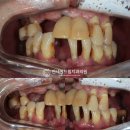 구의동 치과 전악 임플란트 풀케이스 (잔존 치아 발치 및 재식립, 상악동 측방접근법 골이식 동반)