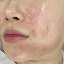 칠링 방배점 | 사당 피부관리 좁쌀 여드름 관리 방배 피부관리 스킨리알에서 받고 온 후기!