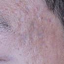 앙코르 | 여드름흉터 치료 전후 비교 사례 첫 번째, 울트라펄스 앙코르 후기, 울트라펄스 알파 후기