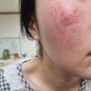 실비청구 실패 주사피부염 열감 온찜질 자비체 판테아신크림 아누아 크림 후기 에스네이처 스쿠알란크림
