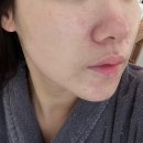 모현동-26 | 익산 모현동 피부관리 여드름흉터 에르떼 해초필링 후기