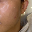 엔젤뷰티 | 동탄 호수공원 여드름 압출 잘하는 곳 / 라크몽 W뷰티 / 엔젤필링 찐 후기 😇