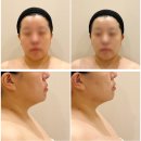 라인온 | 용산에스테틱 위뷰티 용산점, 턱라인 관리 받고 온 후기