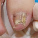 레푸스앤스타일 일산장항점 | 일산 내성발톱 살 찌르는 발톱 케어 레푸스 일산 장항점에서 관리받은 후기