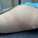 스칼프디자인센터 | [수원 튼살커버잘하는곳] 스킨52 더광교 스칼프스킨디자인센터 튼살커버 솔직후기