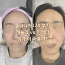 리즈힐의원 | 올리디아120 캐뉼라 vs 인젝터(하이쿡수) 후기 뭐가 더 아플까? 붓기·멍·유지기간 비교