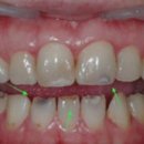 강남심미치과보철과치과의원 | 거뭇거뭇한 앞니 충치, 라미네이트로 깔끔하게 해결｜강남 치과 증례