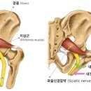 엉덩이나 다리의 통증 및 저림, 엉덩이에서 다리로 퍼지는 통증이나 저림 있으신 분들 보세요 이미지