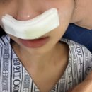 [연산 부산행복이비인후과] 만성부비동염/코물혹/염증 외 수술후기