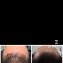 533 | 대전 두피커버 탈모케어 이제이뷰티 신탄진 두피숱채움 자연결눈썹