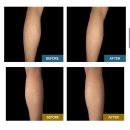 좋은약국 | 효과 좋은 약국 파스 ‘아르니패치’ 사용 후기 멍패치, 붓기완화패치, 근육통패치, 근육통푸는법, 붓기...