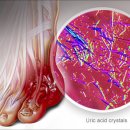 통풍 치료법 이미지