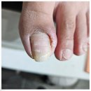 패디 후 불편함 바로잡은 대구 내성발톱케어샵 내일도네일해 후기