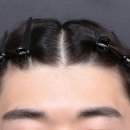 서강초교 | 신촌탈모병원, 정수리 메조 시작한 지 2개월 된 후기 (중간점검)