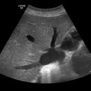 engorgement of heptic veins and IVC. 이미지