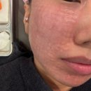 맥스샤인 | 인천 구월동 피부과 더마샤인 리쥬란맥스 후기 (통증, 주기, 효과)
