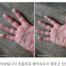 손 혈자리 수지요법 | 구리한의원 - 밤마다 손저림… 방아쇠수지·손목 터널증후군, 봉침 포함 비수술 한방치료 후기