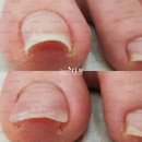 산호동476 | 참기힘든 내성발톱 페디아이티엔 3zero시스템을 만나면 달라집니다! 교정 후 고통 안녕~