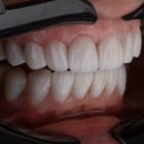 미백클린 | 덴티오클린 후기 효과와 주의사항 완벽 정리