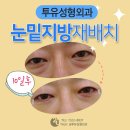 눈밑지방재배치 아주 잘하는곳을 골라서 이미지