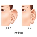 돌출귀(Prominent Ear) 성형미용이란? 이미지