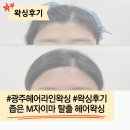 네딘 | 좁은 엠자이마 탈출을 위한 광주 농성동 루네디뷰티 방문기(feat.헤어라인왁싱)