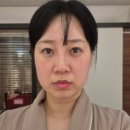 위엠케이 | 성신여대리프팅은 엠케이에스테틱- 3cm리프팅 받고 진짜 올라간 내얼굴 후기