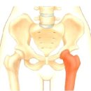 고관절통증/ 고관절인공관절수술/ 고관절수술방법 이미지