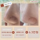 더 베스트 | 홍대피부관리 여드름 관리 받은 후기 &#39;미더베스트 홍대&#39;