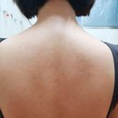 반성한의원 | 대구 등드름 등여드름 한의원 치료 후기에요