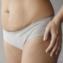 지유네피부과의원 | 대연동피부과 출산후 하얀튼살 붉은튼살 차이