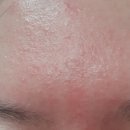 나에개 | 청소년 여드름 화장품 효과 제대로 본 후기 품 + 사진