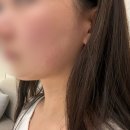 리피부과의원 | 강남역 피부과 레이저리프팅 맛집! 인모드 2회차 후기