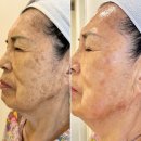 꼼브레 | [공지] 광주피부관리 꼼브레스킨살롱- 계림동 색소관리 매끈 클린업