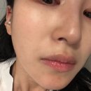 피코슈어프락셀 + 물광톡스로 모공축소 1회차 후기
