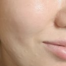 청담수여성의원 | 청담 보톡스로 얼굴 윤곽관리와 이마 주름개선까지 같이 된 후기