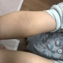 바름태권도장 | 아토피일기 21.05.25.(화) _피부완정중단