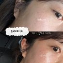 수성레이저 | 대구 수성구 피부과 내돈내산 루비레이저로 기미잡티제거 후기