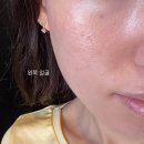 하나의원 앞 | 여의도 피부과 유스의원 모공시술 내돈내산 후기