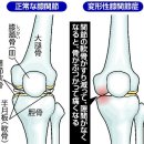 무릎을 소중히 （１）비만은 연골(軟骨)의 大敵 이미지