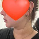 닥터 노하우 | 수원 올타이트리프팅 V라인 만들기 키닥터원장님 후기 비포애프터