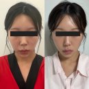보가뷰티 | 강남경락추천 웨딩관리로 선택한 가인미가 강남신논현점 얼굴축소 프리미엄 , 광대관리 후기, 서초경락
