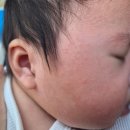 더마웰피부과의원 | [생후 52일] 탄탄이 태열 극복기! #더마웰피부과의원