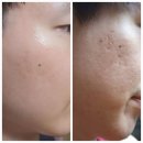미남인셀덤 | 아들의 피부 고민 해결기 인셀덤 사용 후기 대공개